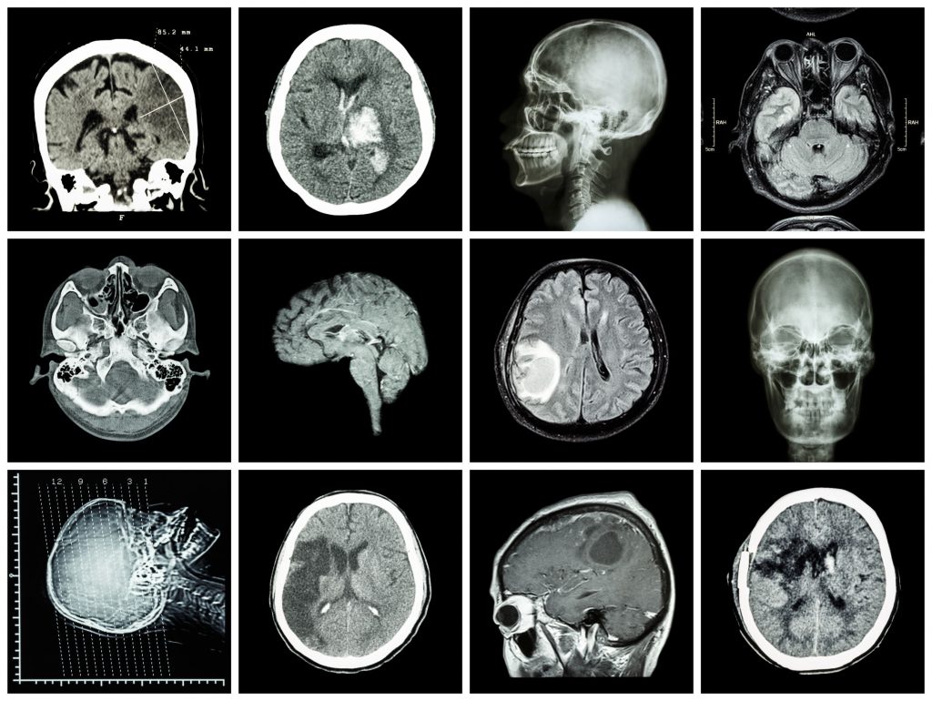 CT Scan and MRI